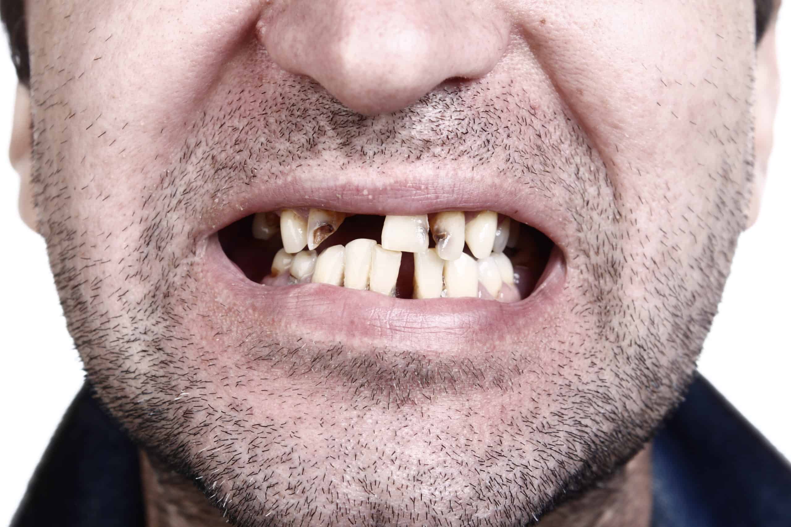 Read more about the article Meth Mouth: A Consequence of Methamphetamine Abuse You Need to See to Believe