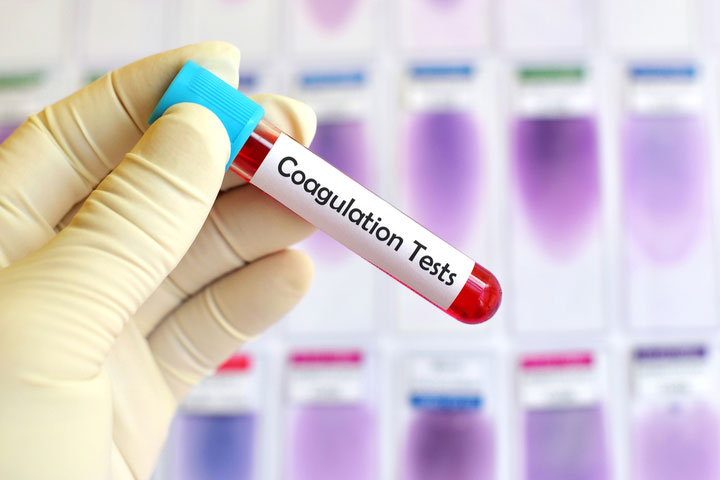 Read more about the article What is Coagulation Testing? Everything You Need to Know About Coagulation Testing