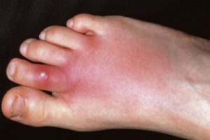 Foot Rash: Symptoms, Causes, and Treatments You Need to Know - Speedy ...