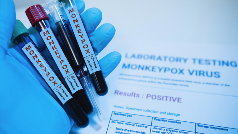 You are currently viewing Does the Monkeypox Virus Cause Flu-Like Symptoms?